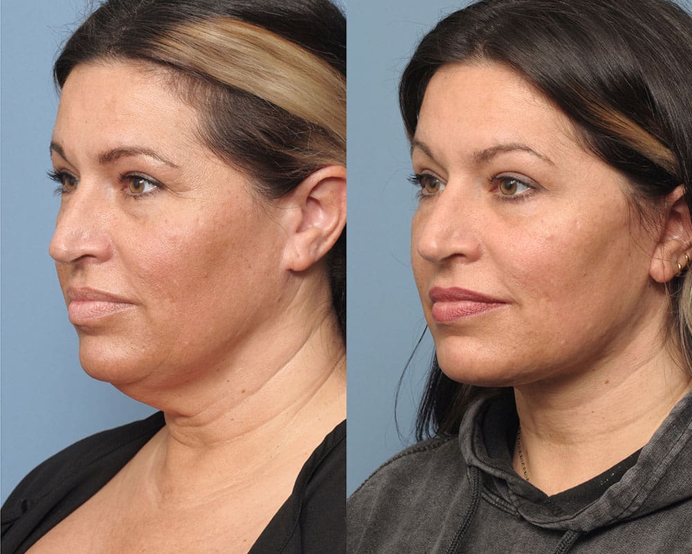 Facelift Long Island Ny Queens Neck Lift