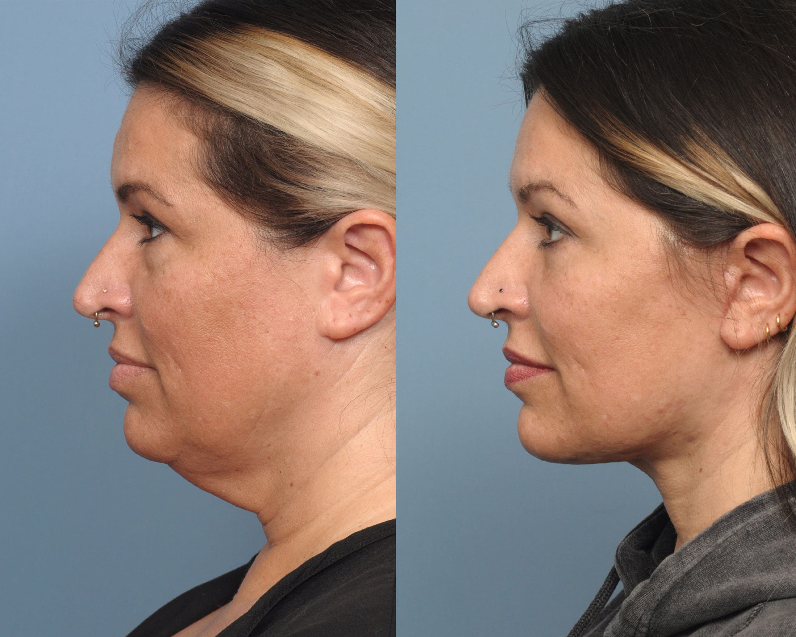 Facelift Long Island Ny Queens Neck Lift